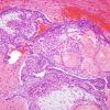 10A7 Craniopharyngioma (Case 10) H&E 6