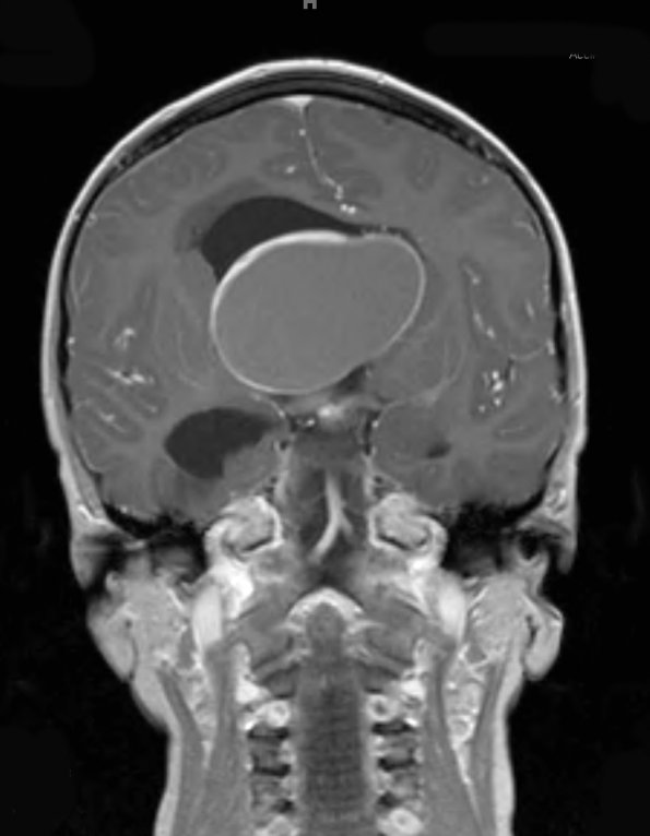 11A3 Craniopharyngioma (Case 11) T1 W - Copy