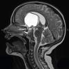 11A4 Craniopharyngioma (Case 11) T2 W 1 - Copy