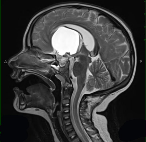 11A4 Craniopharyngioma (Case 11) T2 W 1 - Copy