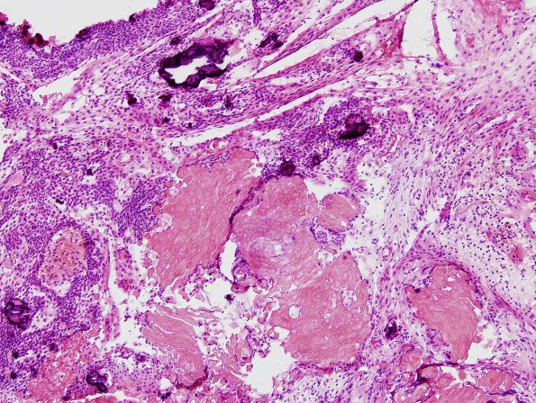 11B Craniopharyngioma (Case 11) H&E 1