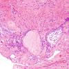 12A2 Craniopharyngioma (Case 12) 7