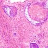 12A3 Craniopharyngioma (Case 12) 3