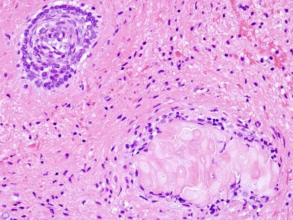 12A5 Craniopharyngioma (Case 12) 8