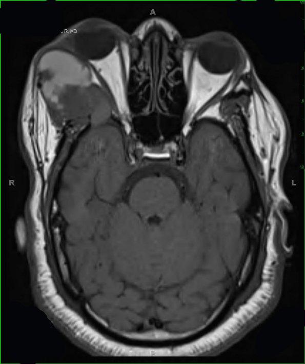 13A1 Craniopharyngioma (Case 13) T1 1 - Copy