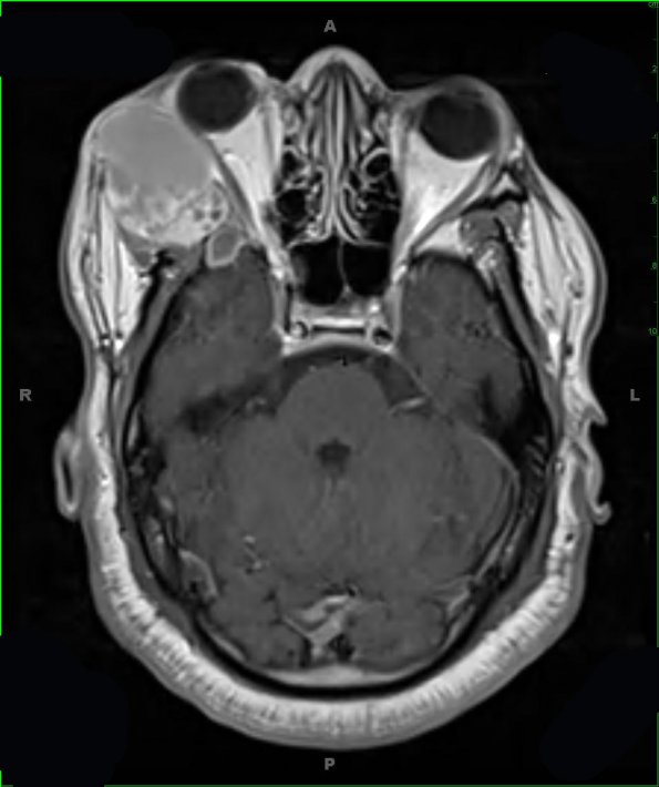 13A2 Craniopharyngioma (Case 13) T1 W 1 - Copy