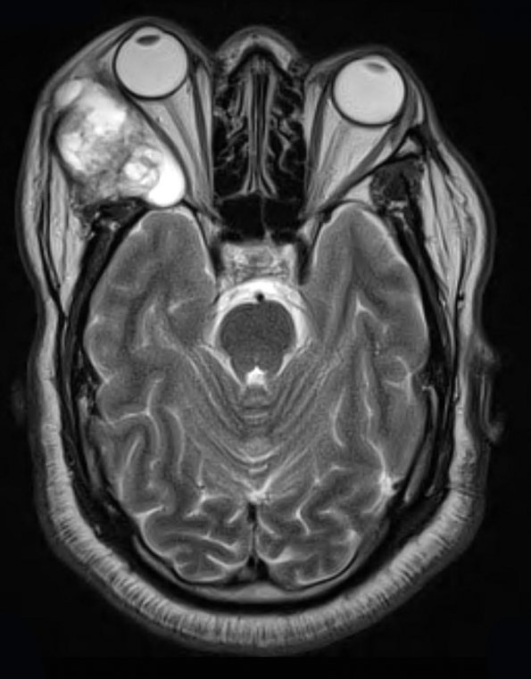 13A3 Craniopharyngioma (Case 13) T2 W 1 - Copy