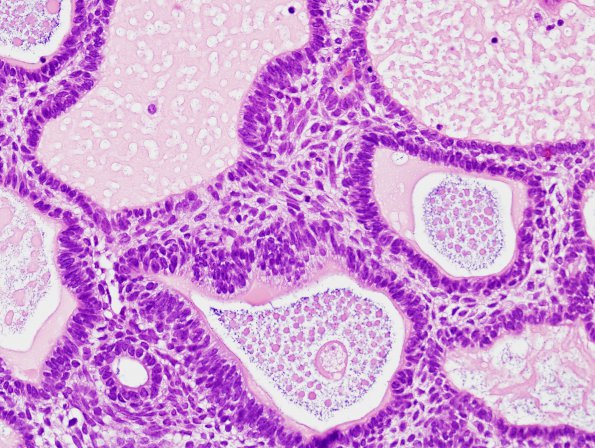 13C2 Craniopharyngioma (Case 13) H&E 4