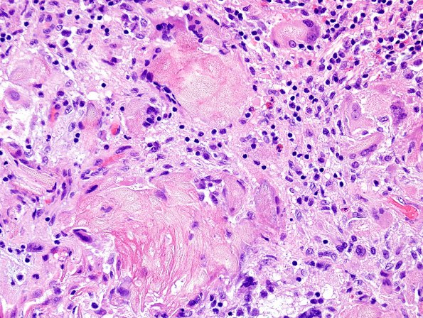 14A3 Cranio SP resection, no live tumor (Case 14) H&E 1.jpg