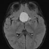 16A1 Craniopharyngioma (Case 16) FLAIR - Copy - Copy