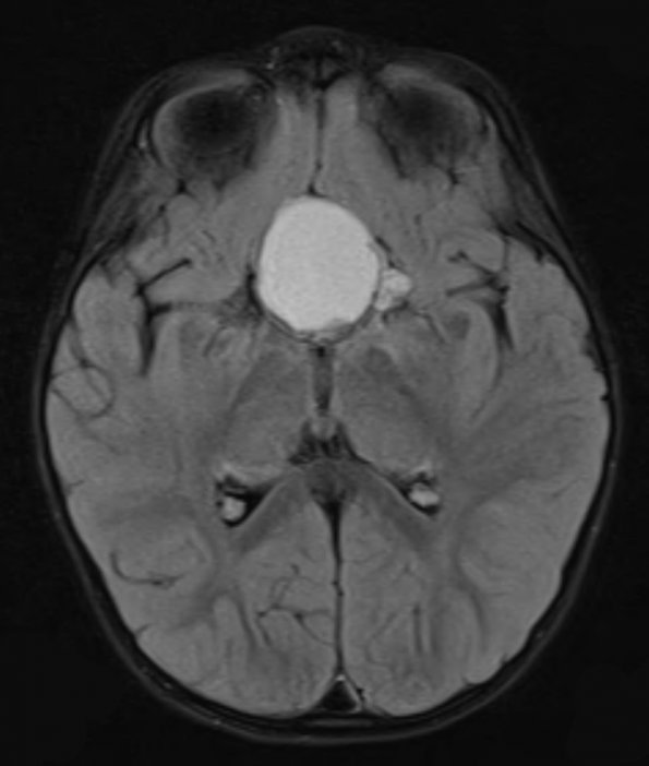 16A1 Craniopharyngioma (Case 16) FLAIR - Copy - Copy