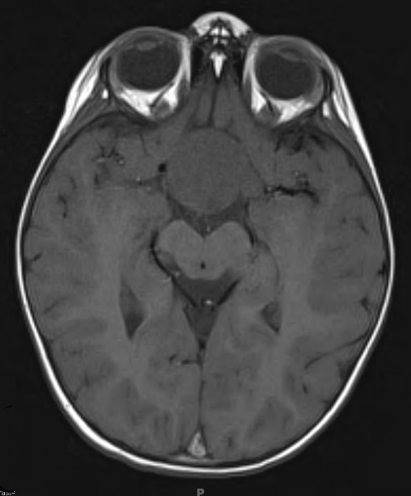 16A2 Craniopharyngioma (Case 16) T1 2 - Copy - Copy