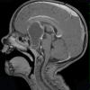 16A5 Craniopharyngioma (Case 16) T1 W 1 - Copy - Copy