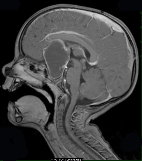 16A5 Craniopharyngioma (Case 16) T1 W 1 - Copy - Copy