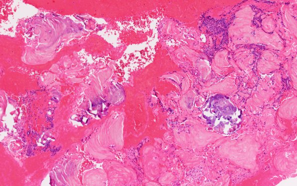 16B Craniopharyngioma (Case 16) H&E 10X