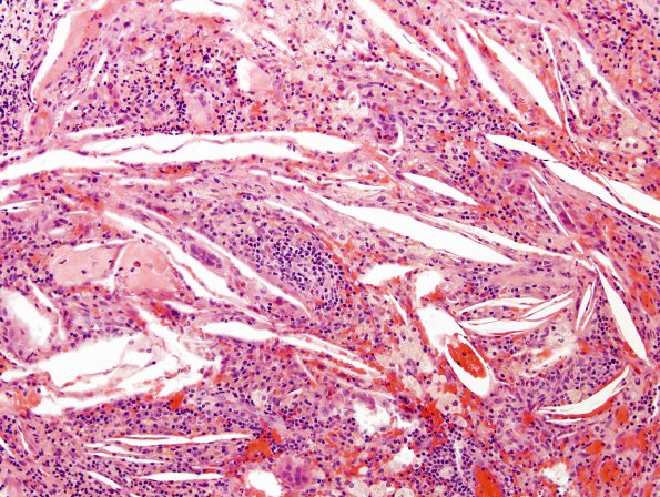 17A3 Craniopharyngioma (Case 17) H&E 2