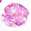 17A4 Craniopharyngioma (Case 17) H&E5