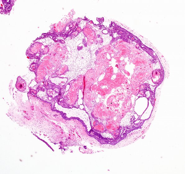 17A4 Craniopharyngioma (Case 17) H&E5