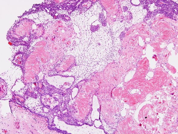 17A5 Craniopharyngioma (Case 17) H&E4