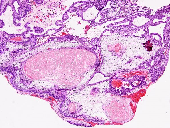 17A6 Craniopharyngioma (Case 18) H&E3