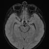 18A1 Craniopharyngioma, Adamantinomatous (Case 18) FLAIR 1 - Copy - Copy