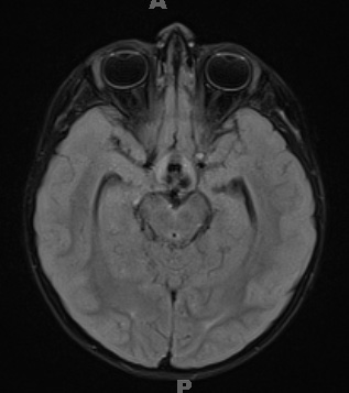 18A1 Craniopharyngioma, Adamantinomatous (Case 18) FLAIR 1 - Copy - Copy