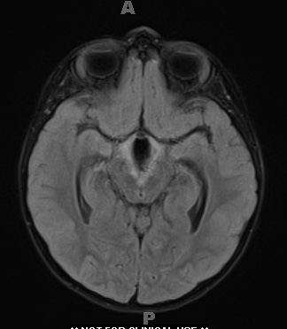 18A2 Craniopharyngioma, Adamantinomatous (Case 18) FLAIR 2 - Copy - Copy