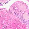 18B2 Craniopharyngioma, Adamantinomatous (Case 19) 20X 3