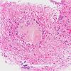 18B3 Craniopharyngioma, Adamantinomatous (Case 18) 20X