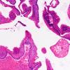 1C Craniopharyngioma, H&E (Case 1)  10X