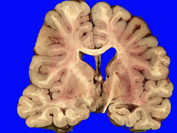 1D2 Cranio & radiation Rx 3 yr prior Case 1) 4