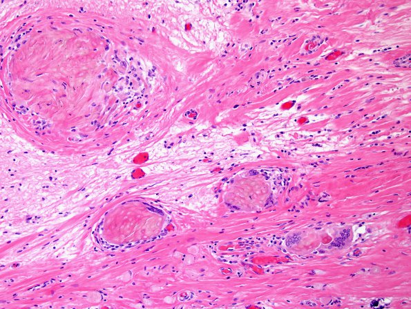 1E4 Cranio & radiation Rx 3 yr prior Case 1) N12 H&E 1.jpg