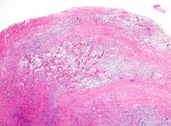 1F1 Pit Cranio & radiation Rx 3 yr prior Case 1) 2.jpg