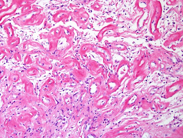 1F2 Pit Cranio & radiation Rx 3 yr prior Case 1) 3.jpg