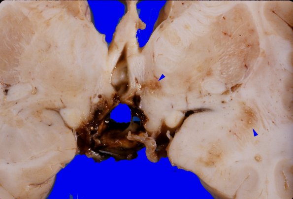 20A3 Craniopharyngioma (Case 20) 5 copy