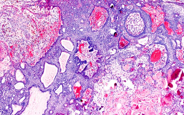 20B3 Craniopharyngioma (Case 20) 10X