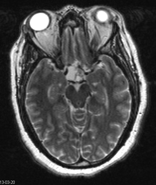 2A1 Craniopharyngioma, adamantinomatous (Case 2) T2 W 1 - Copy - Copy