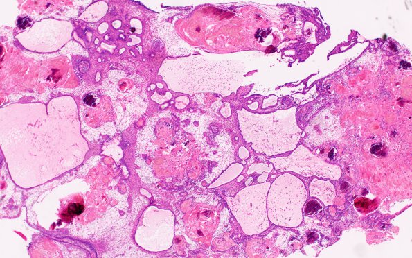 2B1 Craniopharyngioma, adamantinomatous (Case 2) H&E 4X