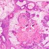 2B2 Craniopharyngioma, adamantinomatous (Case 2) H&E 10X