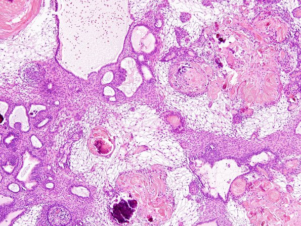 2B3 Craniopharyngioma, adamantinomatous (Case 2) H&E 2.jpg