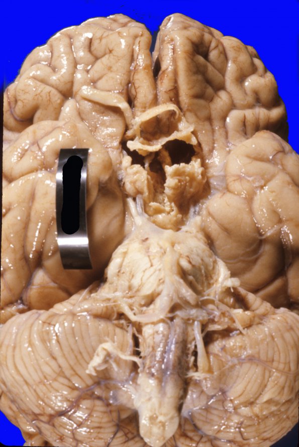 3A1 Craniopharyngioma (Case 3) 7