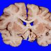 3A2 Craniopharyngioma (Case 3) 8