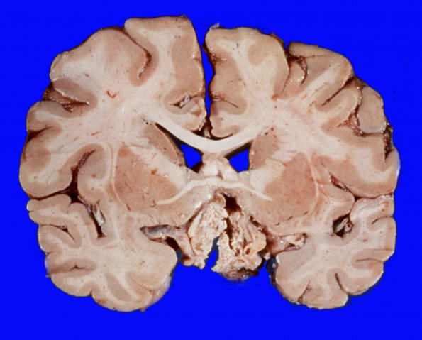 3A2 Craniopharyngioma (Case 3) 8