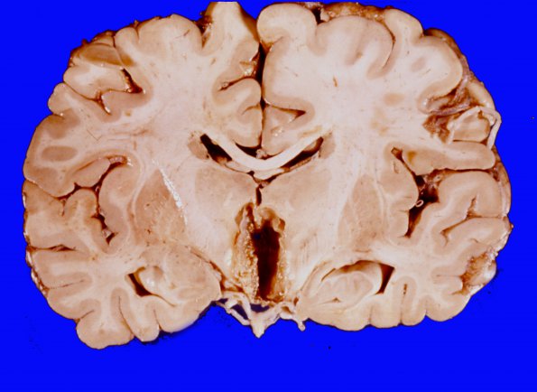 3A3 Craniopharyngioma (Case 3) 9