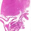 3B1 Craniopharyngioma, adult (Case 3) H&E whole mount