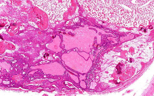 3B2 Craniopharyngioma, adult (Case 3) H&E 4X