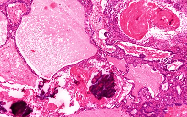 3B3 Craniopharyngioma, adult (Case 3) H&E 10X