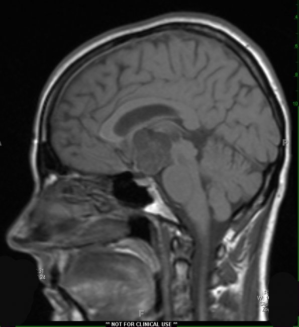 4A2 Craniopharyngioma (Case 4) T1 1 - Copy