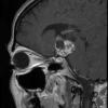 4A3 Craniopharyngioma (Case 4) T1 with contrast 2A - Copy