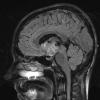 4A4 Craniopharyngioma (Case 4) T2 2 - Copy